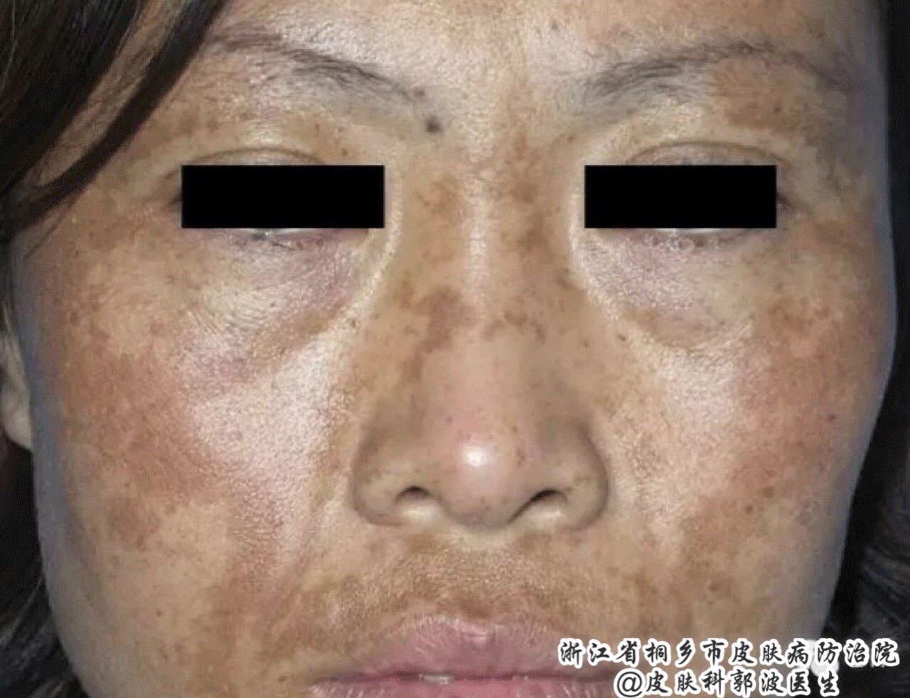 认识一下的因素造成的脸斑会产生不同的斑点怎么办