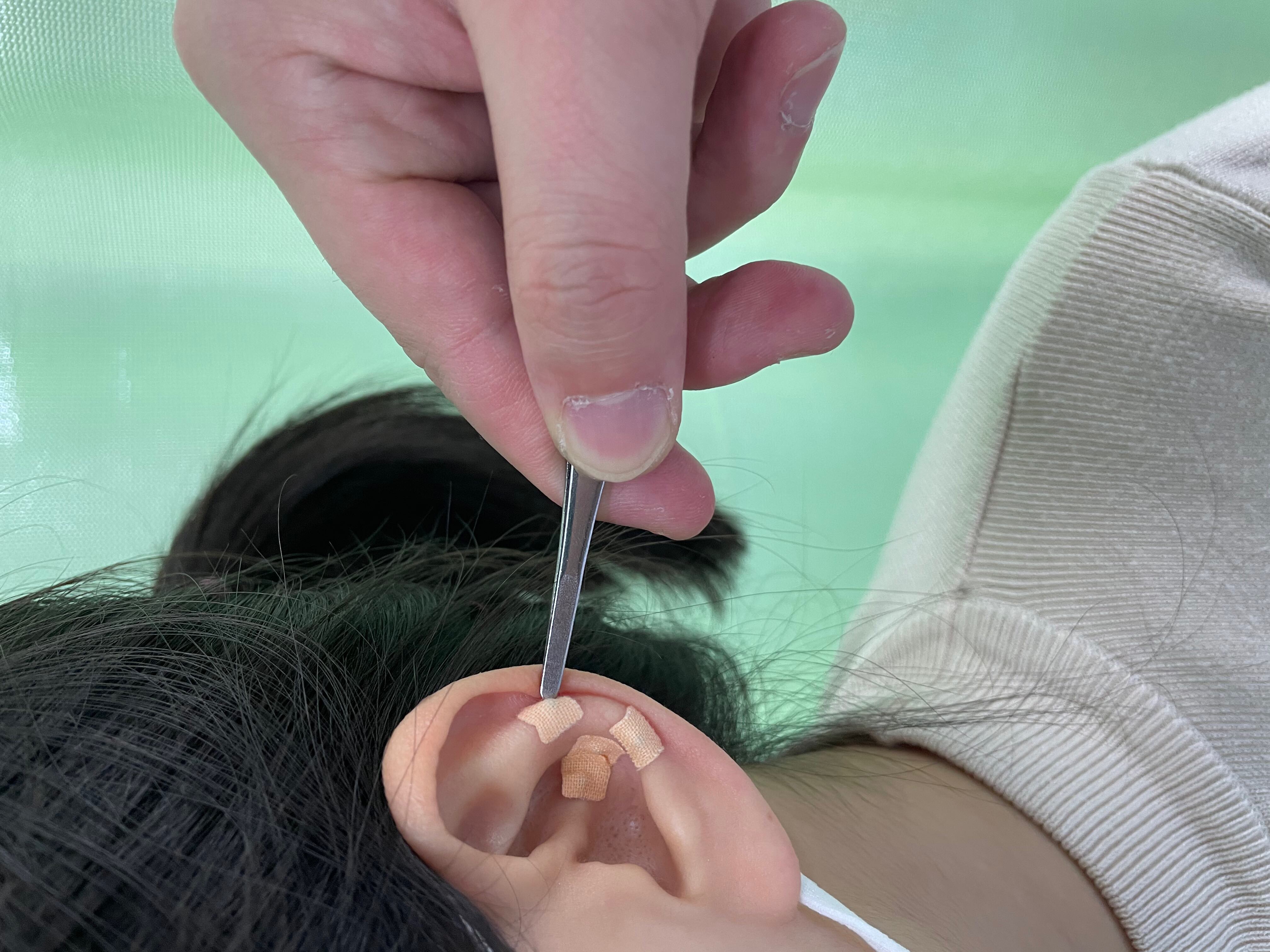耳穴压豆治疗耳鸣的疗效满意吗？